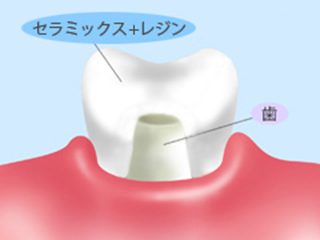 ハイブリッドセラミック