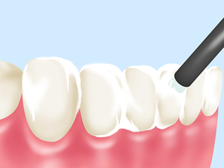 初期の虫歯を再石灰で治療