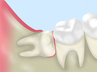 親知らずの抜歯