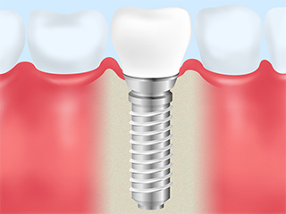山村歯科のインプラント治療