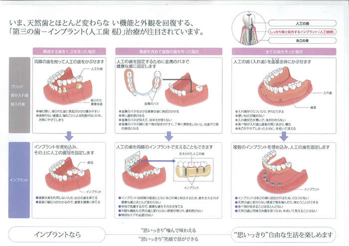 山村歯科のインプラント治療早見表