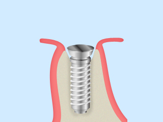 Step 1 人工歯根の埋入