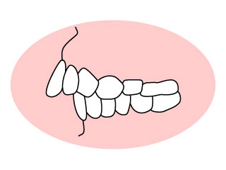 上顎前突（じょうがくぜんとつ）