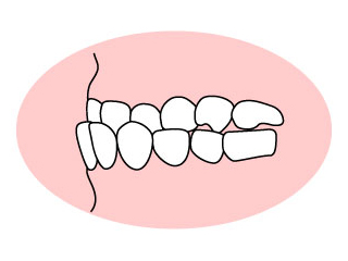 下顎前突（かがくぜんとつ）・反対咬合（はんたいこうごう）
