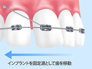 インプラント矯正