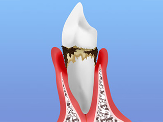 歯周病の原因